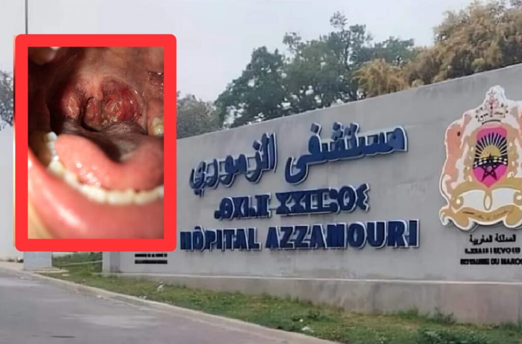 القصة الكاملة لمغادرة مصاب بالدفتيريا مستشفى القنيطرة وإعادته من طرف السلطات ووضعه تحت الحجر الصحي